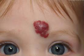 U mạch máu - Hình ảnh minh họa